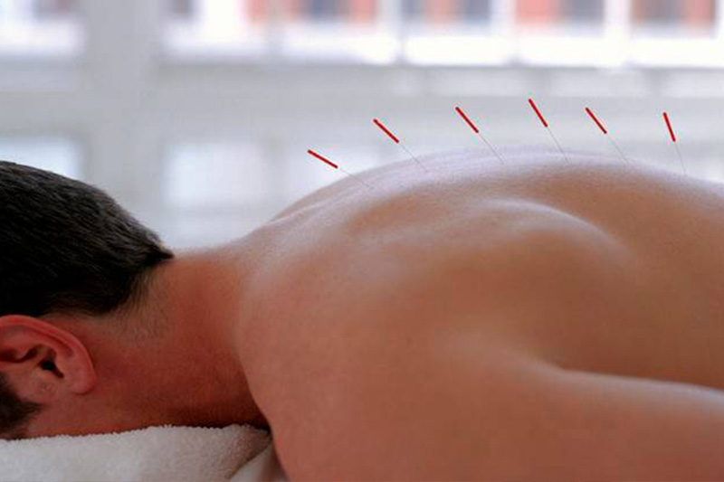 Acupuncture Therapy back